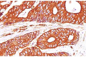 Immunohistochemistry of paraffin-embedded Human carcinoma of Colon using Sptan1 Polyclonal Antibody at dilution of 1:100(400x) (SPTAN1 antibody)