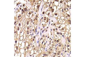 Immunohistochemistry of paraffin-embedded human kidney cancer using TCEB3 antibody at dilution of 1:100 (x400 lens). (TCEB3 antibody)
