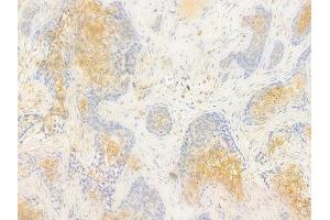 ABIN7096990 and ABIN7101057 at 1/100 staining human breast carcinoma by IHC-P.