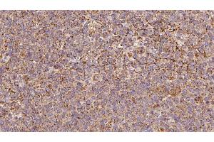 ABIN6273193 at 1/100 staining Human lymph cancer tissue by IHC-P. (ARHGDIB antibody  (N-Term))