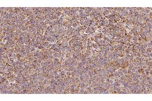 ABIN6273193 at 1/100 staining Human lymph cancer tissue by IHC-P. (ARHGDIB antibody  (N-Term))