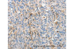 Immunohistochemistry of Human esophagus cancer using APOH Polyclonal Antibody at dilution of 1:30