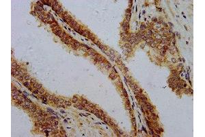 IHC image of ABIN7162643 diluted at 1:700 and staining in paraffin-embedded human prostate cancer performed on a Leica BondTM system. (PTH antibody  (AA 32-115))