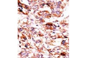 Formalin-fixed and paraffin-embedded human cancer tissue reacted with the primary antibody, which was peroxidase-conjugated to the secondary antibody, followed by AEC staining. (ADCK5 antibody  (C-Term))