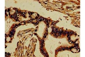 Immunohistochemistry of paraffin-embedded human pancreatic cancer using ABIN7174072 at dilution of 1:100 (ROR2 antibody  (AA 752-926))