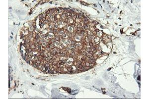 Immunohistochemical staining of paraffin-embedded Adenocarcinoma of Human breast tissue using anti-ENPEP mouse monoclonal antibody.
