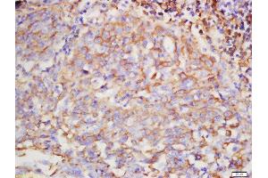 Formalin-fixed and paraffin embedded human lung carcinoma labeled with Rabbit Anti-Hyaluronidase2 Polyclonal Antibody, Unconjugated  at 1:200 followed by conjugation to the secondary antibody and DAB staining (HYAL2 antibody  (AA 111-210))