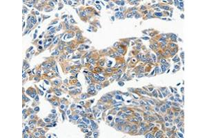 Immunohistochemical analysis of paraffin-embedded Human lung cancer tissue using at dilution 1/50. (CCL23 antibody  (C-Term))