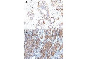 Immunohistochemical staining (Formalin-fixed paraffin-embedded sections) of human breast carcinoma (A) and human leiomyosarcoma (B) with MYH11 monoclonal antibody, clone SMMS-1 . (MYH11 antibody)