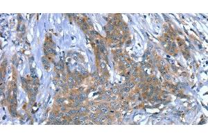 Immunohistochemistry of paraffin-embedded Human cervical cancer using SCPEP1 Polyclonal Antibody at dilution of 1:30 (SCPEP1 antibody)