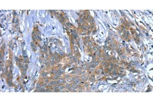 Immunohistochemistry of paraffin-embedded Human cervical cancer using SCPEP1 Polyclonal Antibody at dilution of 1:30