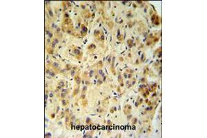 FUCA1 Antibody IHC analysis in formalin fixed and paraffin embedded human hepatocarcinoma followed by peroxidase conjugation of the secondary antibody and DAB staining.
