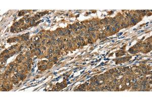 Immunohistochemistry of paraffin-embedded Human gastic cancer using Cathepsin E Polyclonal Antibody at dilution of 1:40 (Cathepsin E antibody)