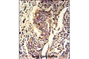 Formalin-fixed and paraffin-embedded human lung carcinoma reacted with KYNU Antibody , which was peroxidase-conjugated to the secondary antibody, followed by DAB staining.