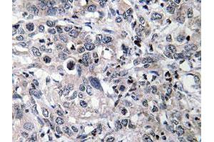 Immunohistochemical analysis of paraffin-embedded human liver carcinoma tissue using CYP2C19 polyclonal antibody . (CYP2C19 antibody)