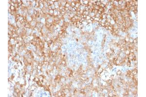 Formalin-fixed, paraffin-embedded human Lung Tumor stained with HLA-DR Mouse Monoclonal Antibody (TAL 1B5). (HLA-DR antibody)