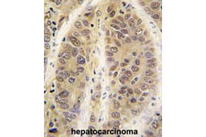 Formalin-fixed and paraffin-embedded human hepatocarcinomareacted with ADK polyclonal antibody , which was peroxidase-conjugated to the secondary antibody, followed by AEC staining. (ADK antibody  (C-Term))