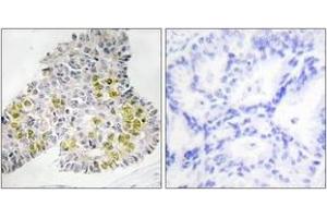 Immunohistochemistry analysis of paraffin-embedded human lung carcinoma tissue, using LKB1 (Ab-428) Antibody. (LKB1 antibody  (AA 384-433))