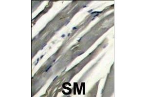 Formalin-fixed and raffin-embedded human hetocarcinoma reacted with RK8 (LRRK2) Antibody  f , which was peroxidase-conjugated to the secondary antibody, followed by DAB staining. (LRRK2 antibody  (AA 878-909))