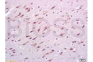 Formalin-fixed and paraffin embedded rabbit brain carcinoma labeled with Anti-VCAM-1/CD106/L1CAM Polyclonal Antibody, Unconjugated (ABIN729838) at 1:300, followed by conjugation to the secondary antibody and DAB staining (VCAM1 antibody  (AA 651-739))