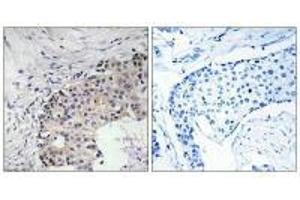 Immunohistochemistry analysis of paraffin-embedded human breast carcinoma tissue using SCARF2 antibody. (SCARF2 antibody)