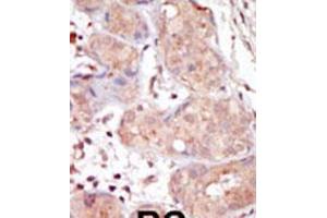 Formalin-fixed and paraffin-embedded human cancer tissue reacted with the primary antibody, which was peroxidase-conjugated to the secondary antibody, followed by DAB staining. (MAK antibody  (C-Term))