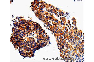 Immunohistochemistry of Human lung cancer using ADD1 Polyclonal Antibody at dilution of 1:50 (alpha Adducin antibody)