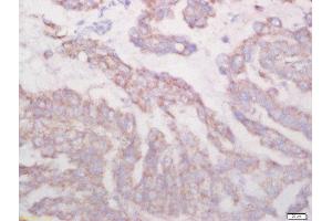 Formalin-fixed and paraffin embedded human lung carcinoma labeled with Rabbit Anti-Biglycan Polyclonal Antibody, Unconjugated (ABIN872817) at 1:200 followed by conjugation to the secondary antibody and DAB staining (Biglycan antibody  (AA 101-200))