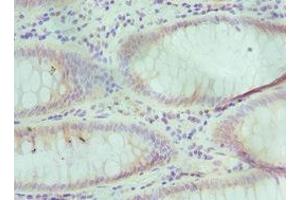 Immunohistochemistry of paraffin-embedded human colon cancer using ABIN7151592 at dilution of 1:100 (TCEB3 antibody  (AA 679-798))