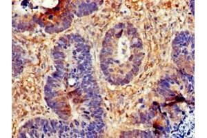 Immunohistochemistry of paraffin-embedded human ovarian cancer using ABIN7147287 at dilution of 1:100 (CDC6 antibody  (AA 1-141))
