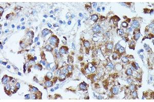 Immunohistochemistry of paraffin-embedded Human liver cancer using PDE3A Polyclonal Antibody at dilution of 1:100 (40x lens). (PDE3A antibody)
