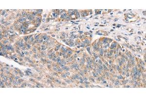 Immunohistochemistry of paraffin-embedded Human ovarian cancer using DECR1 Polyclonal Antibody at dilution of 1:50 (DECR1 antibody)