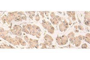 Immunohistochemistry of paraffin-embedded Human gastric cancer tissue using FABP4 Polyclonal Antibody at dilution of 1:60(x200) (FABP4 antibody)