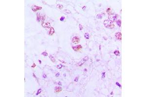 Immunohistochemical analysis of ATF3 staining in human lung cancer formalin fixed paraffin embedded tissue section. (ATF3 antibody  (C-Term))