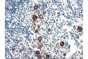 Immunohistochemical staining of paraffin-embedded Carcinoma of Human lung tissue using anti-DPP10 mouse monoclonal antibody. (DPP10 antibody)