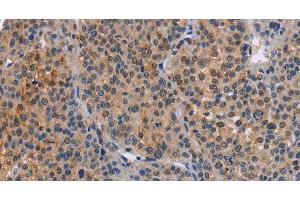 Immunohistochemistry of paraffin-embedded Human liver cancer tissue using MAP3K13 Polyclonal Antibody at dilution 1:40 (MAP3K13 antibody)
