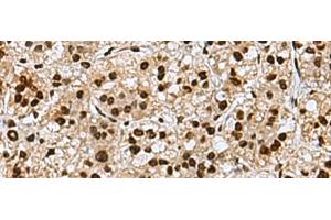 Immunohistochemistry of paraffin-embedded Human liver cancer tissue using MYEF2 Polyclonal Antibody at dilution of 1:70(x200) (MYEF2 antibody)