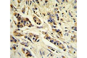 IHC analysis of FFPE human breast carcinoma stained with IL-10 antibody (IL-10 antibody  (AA 27-53))