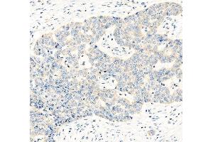 IHC analysis of HE4/WFDC2 using anti-HE4/WFDC2 antibody (ABIN5693137). (WFDC2 antibody  (AA 31-124))