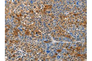 The image on the left is immunohistochemistry of paraffin-embedded Human liver cancer tissue using ABIN7191027(HTRA3 Antibody) at dilution 1/45, on the right is treated with synthetic peptide. (HTRA3 antibody)