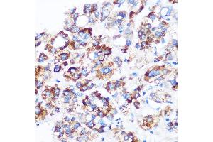 Immunohistochemistry of paraffin-embedded Human liver cancer using C9orf114 Rabbit pAb (ABIN7266390) at dilution of 1:100 (40x lens). (C9orf114 antibody)