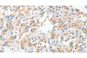 Immunohistochemistry of paraffin-embedded Human thyroid cancer using RPN1 Polyclonal Antibody at dilution of 1:30 (RPN1 antibody)