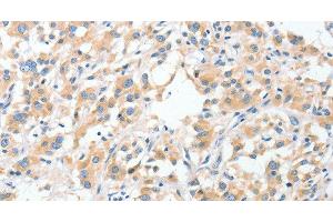 Immunohistochemistry of paraffin-embedded Human thyroid cancer using RPN1 Polyclonal Antibody at dilution of 1:30 (RPN1 antibody)