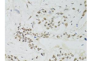 Immunohistochemistry of paraffin-embedded human gastric cancer using PPP4C antibody (ABIN5971135) at dilution of 1/100 (40x lens). (PPP4C antibody)