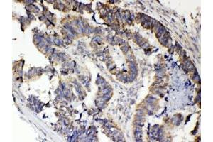 IHC testing of FFPE human intestinal cancer tissue with RANK antibody at 1ug/ml. (TNFRSF11A antibody  (AA 235-262))