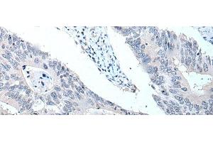 Immunohistochemistry of paraffin-embedded Human colorectal cancer tissue using VPS35 Polyclonal Antibody at dilution of 1:25(x200) (VPS35 antibody)