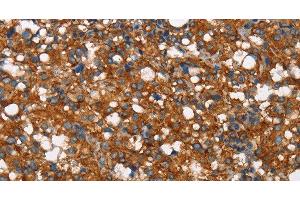 Immunohistochemistry of paraffin-embedded Human thyroid cancer tissue using COX5A Polyclonal Antibody at dilution 1:40 (COX5A antibody)