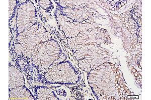Formalin-fixed and paraffin embedded: human colon tubular adenocarcinoma labeled with Anti-PDGF-A Polyclonal Antibody (ABIN726155), Unconjugated at 1:300, followed by conjugation to the secondary antibody and DAB staining