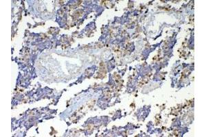 IHC testing of FFPE human lung cancer tissue with Dnmt1 antibody at 1ug/ml.