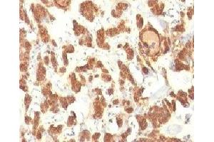 Formalin-fixed, paraffin-embedded human thyroid carcinoma stained with Cytokeratin 18 antibody. (Cytokeratin 18 antibody)
